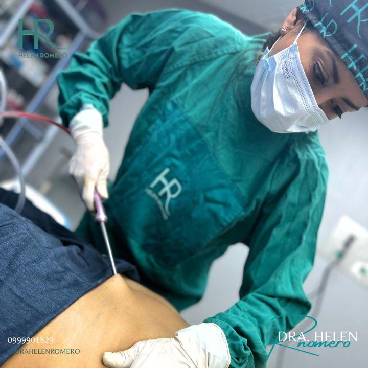 LIPOTRANSFERENCIA transferencia de grasa