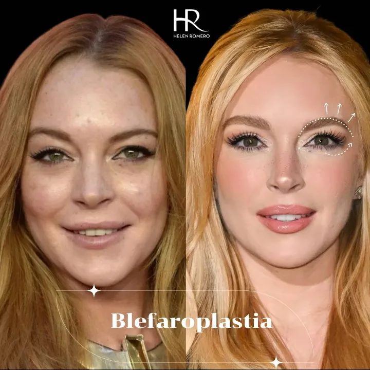 Blefaroplastia