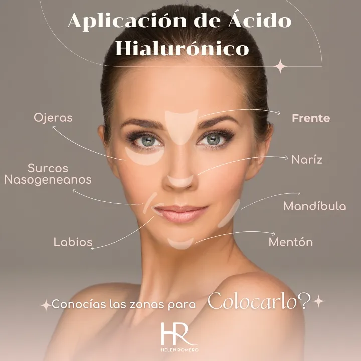 Aplicación Ácido Hialurónico