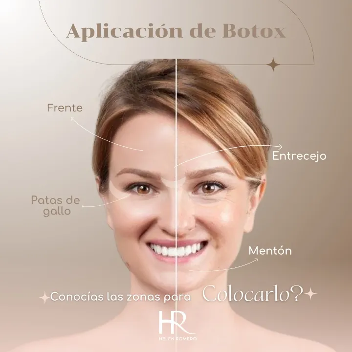 Aplicación Botox