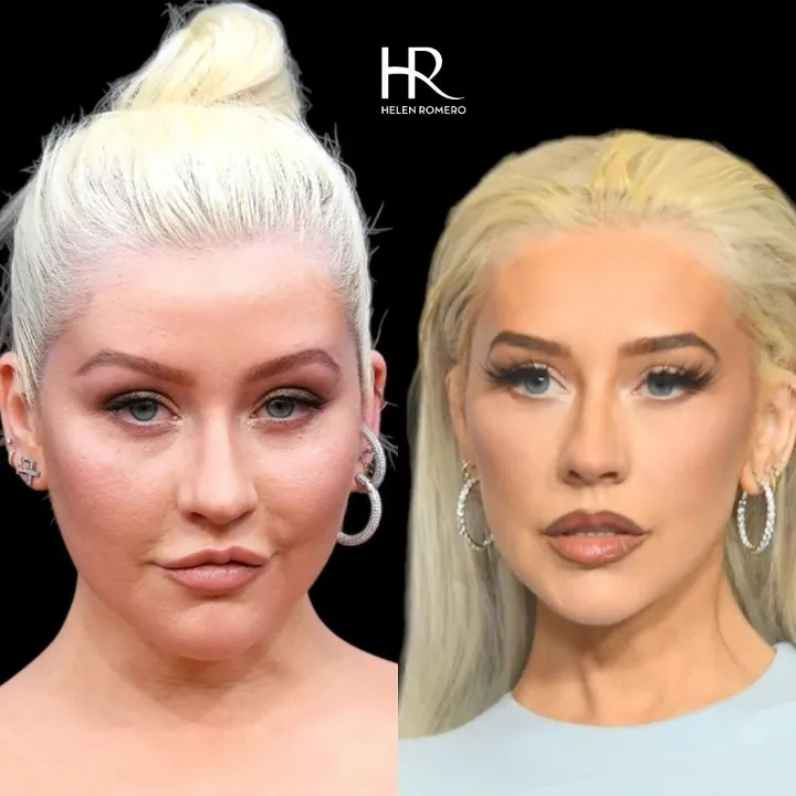 Blefaroplastia